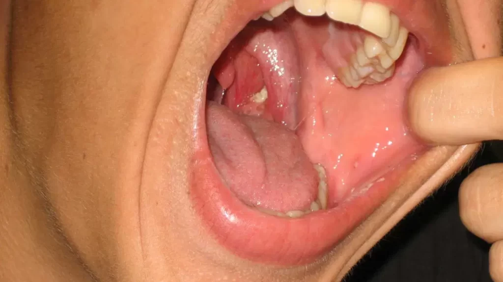 can tonsils grow back after being removed